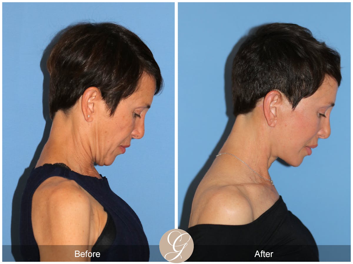 Deep Plane Facelift Before & After Gallery - Patient 214202 - Image 8