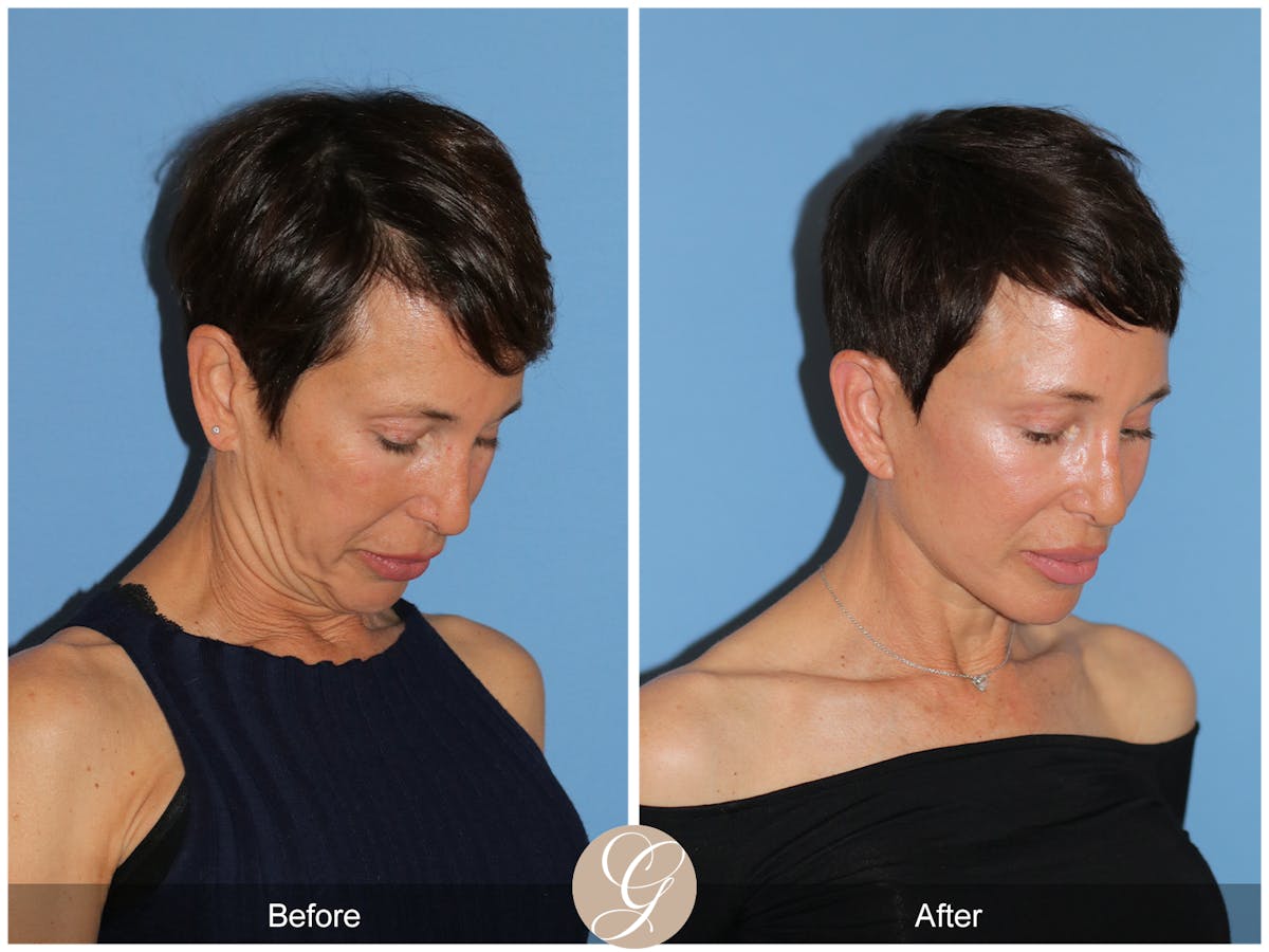 Deep Plane Facelift Before & After Gallery - Patient 214202 - Image 9