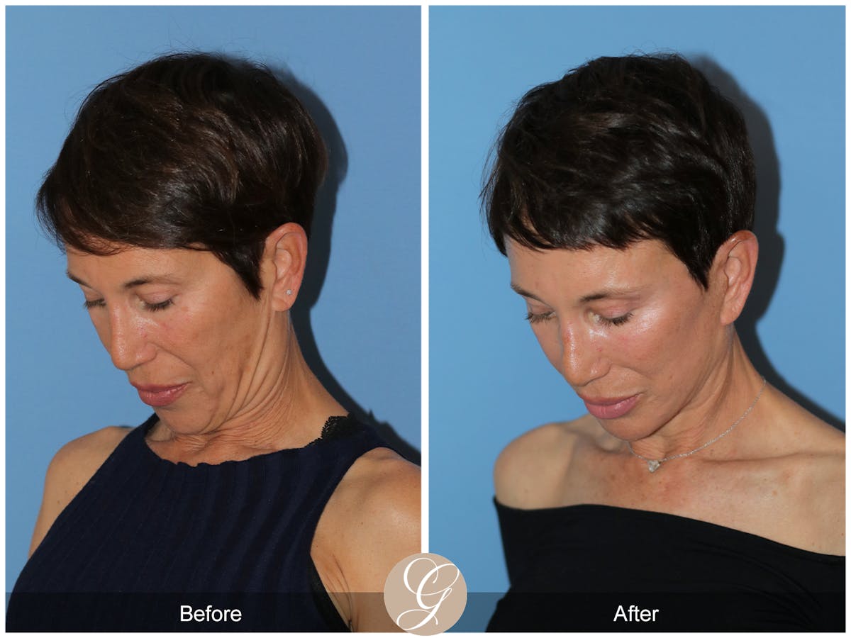 Deep Plane Facelift Before & After Gallery - Patient 214202 - Image 6