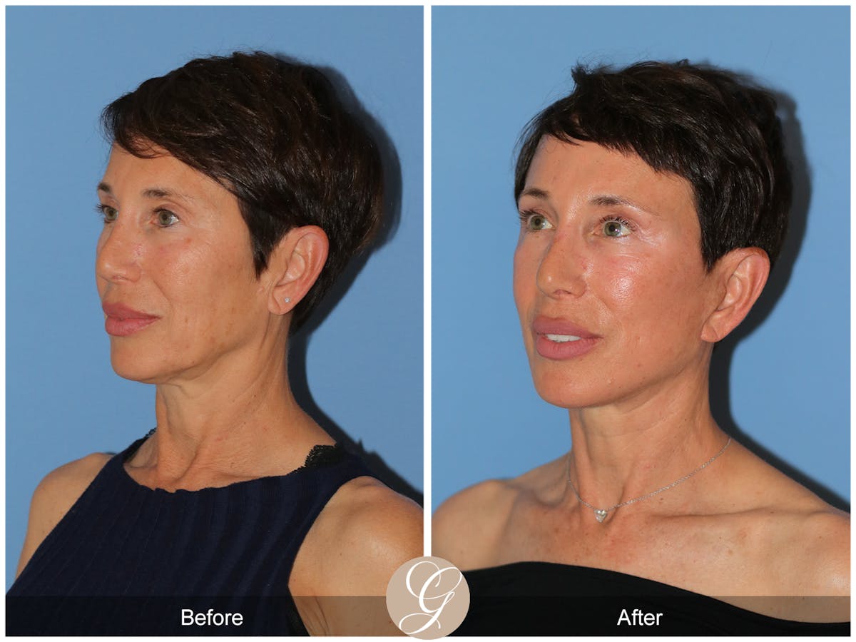 Deep Plane Facelift Before & After Gallery - Patient 214202 - Image 5