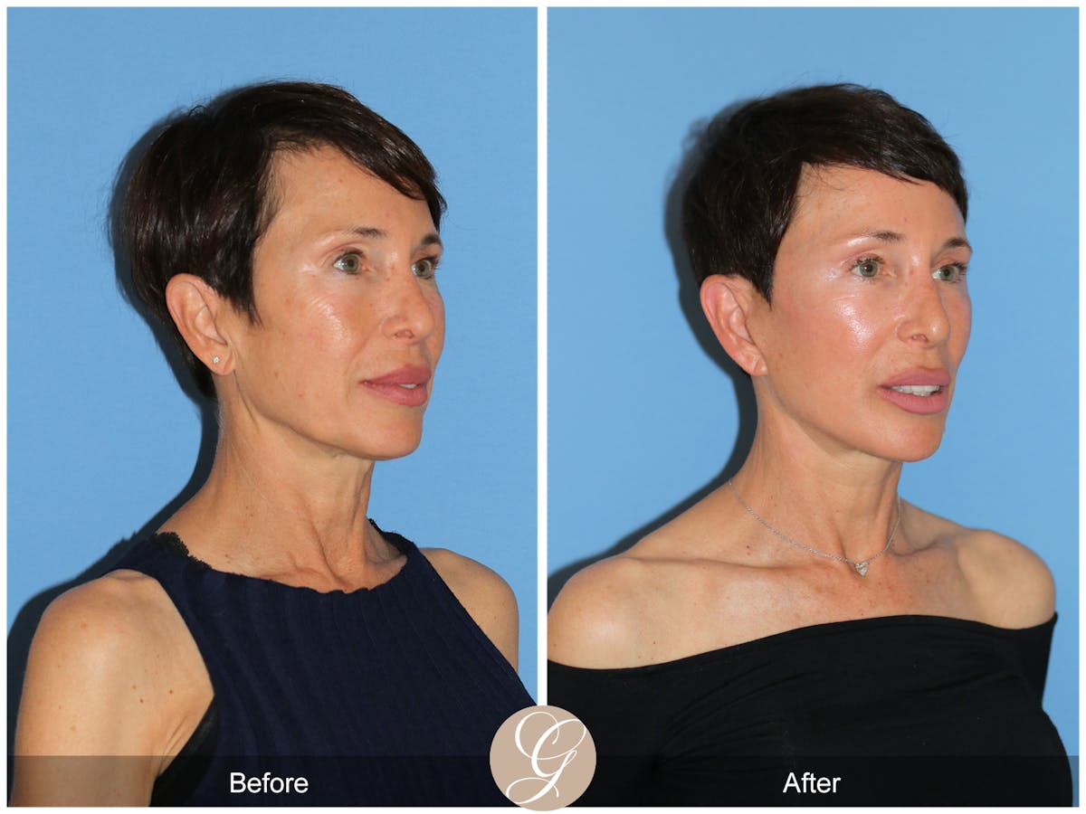 Deep Plane Facelift Before & After Gallery - Patient 214202 - Image 7