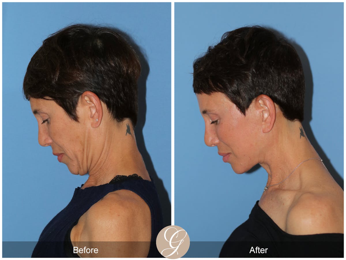 Deep Plane Facelift Before & After Gallery - Patient 214202 - Image 11