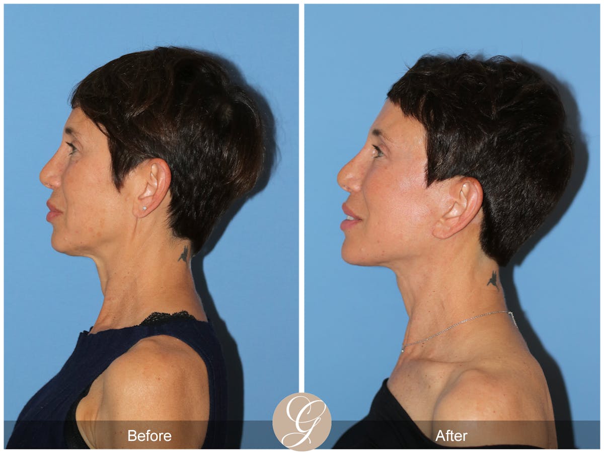 Deep Plane Facelift Before & After Gallery - Patient 214202 - Image 10