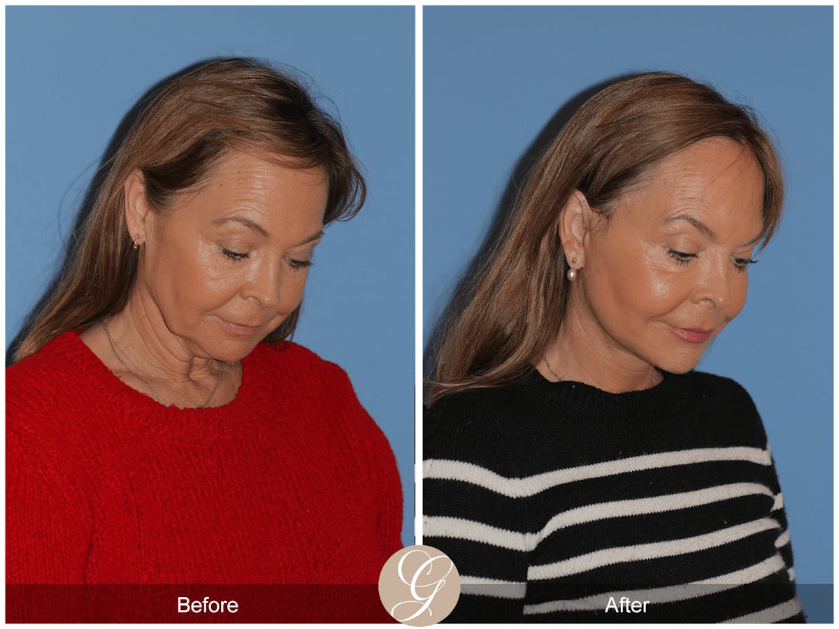 Preservation Facelift Before & After Gallery - Patient 296304 - Image 3