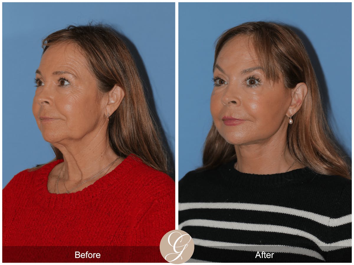 Preservation Facelift Before & After Gallery - Patient 296304 - Image 8