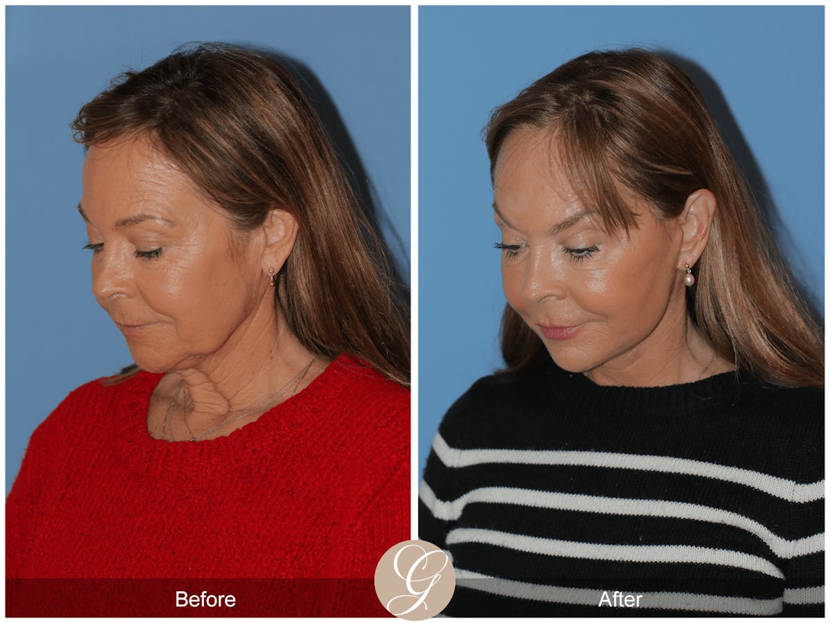 Preservation Facelift Before & After Gallery - Patient 296304 - Image 9