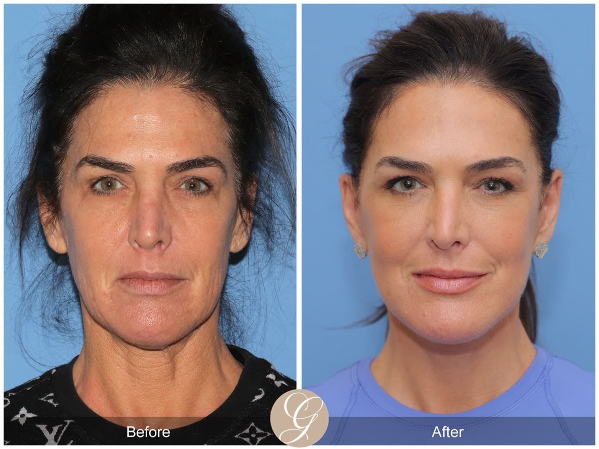 Deep Plane Facelift Before & After Gallery - Patient 425854 - Image 1