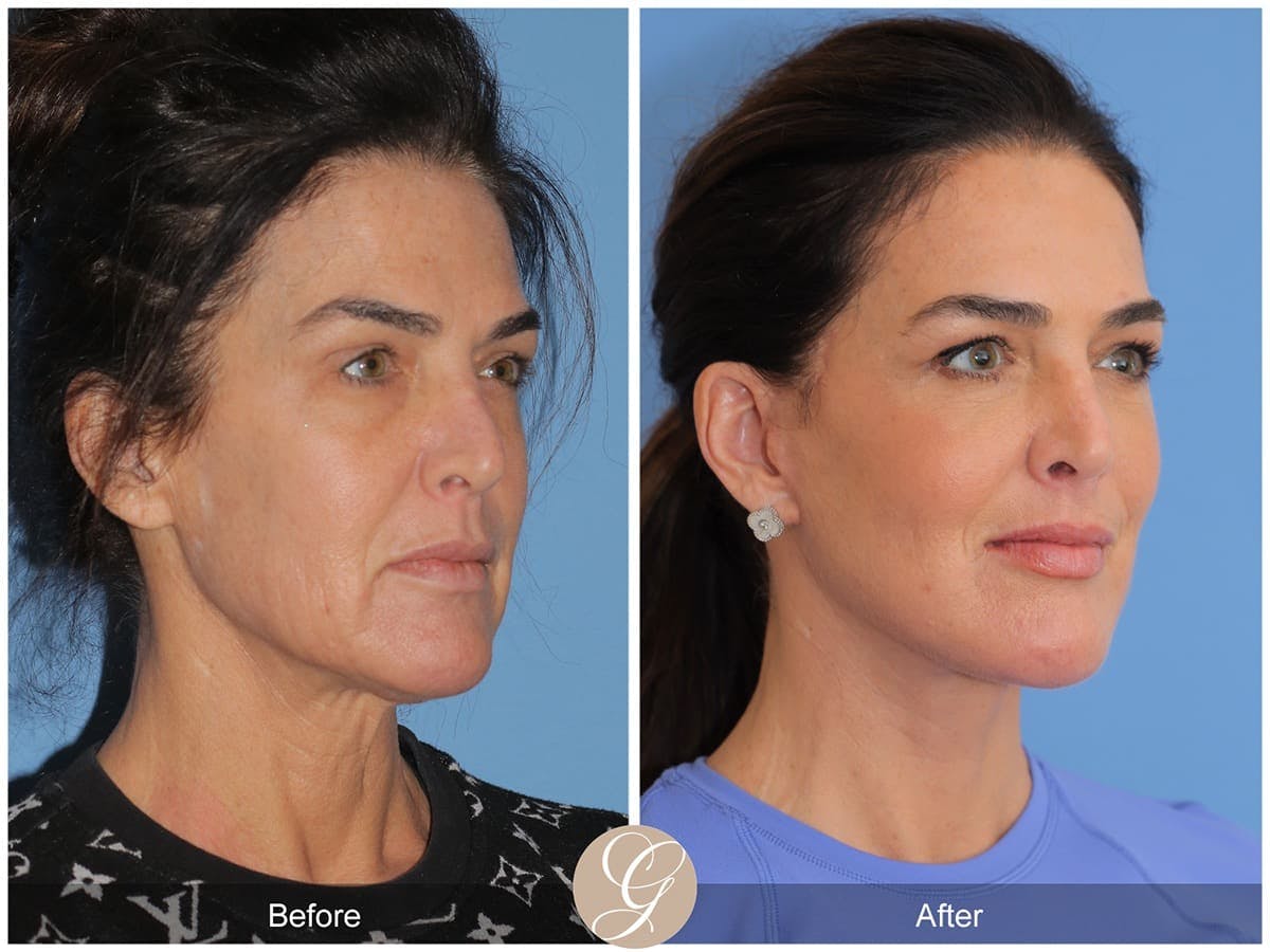 Deep Plane Facelift Before & After Gallery - Patient 425854 - Image 3