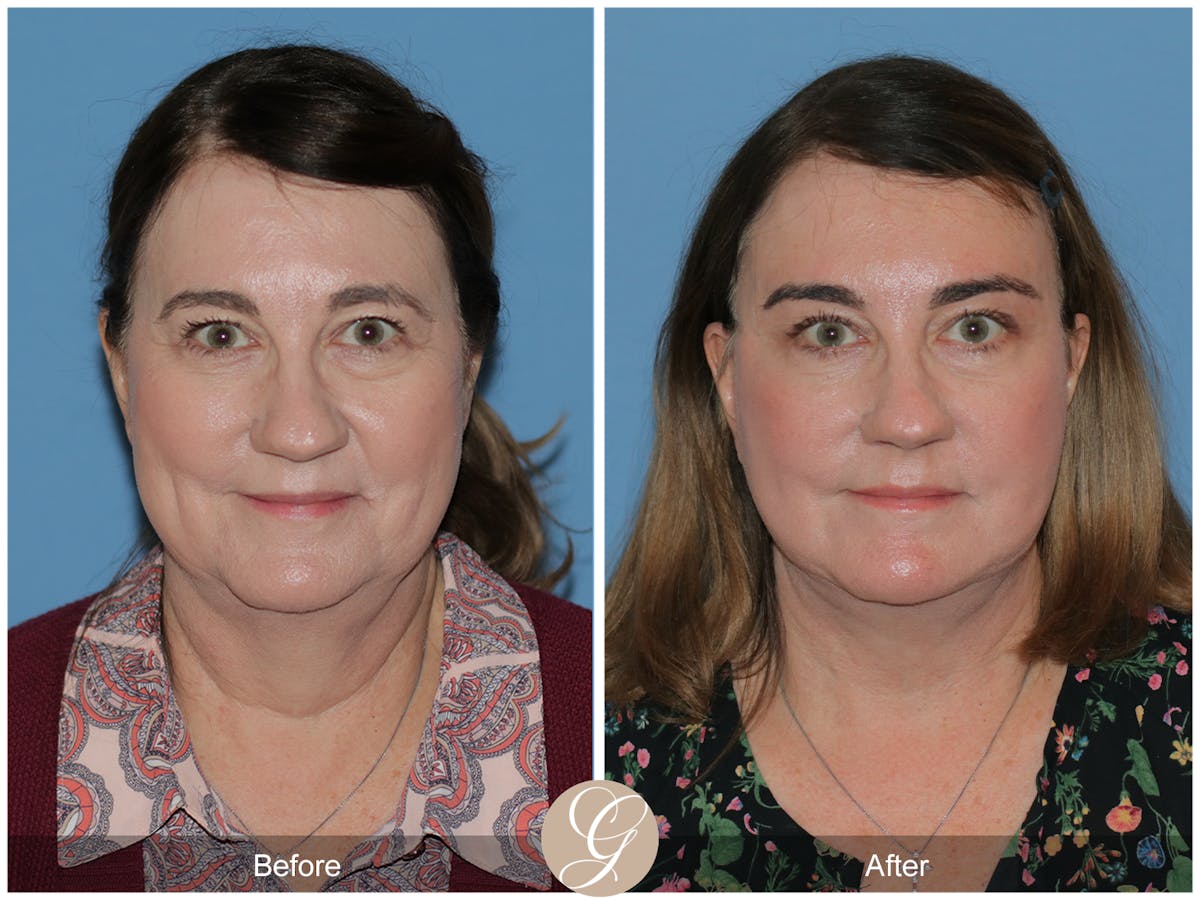 Preservation Facelift Before & After Gallery - Patient 134080 - Image 13