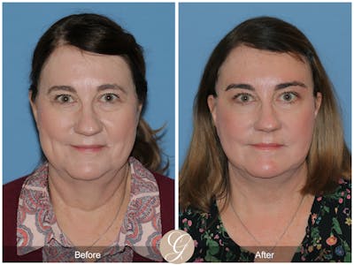 Deep Plane Facelift Before & After Gallery - Patient 357121 - Image 1