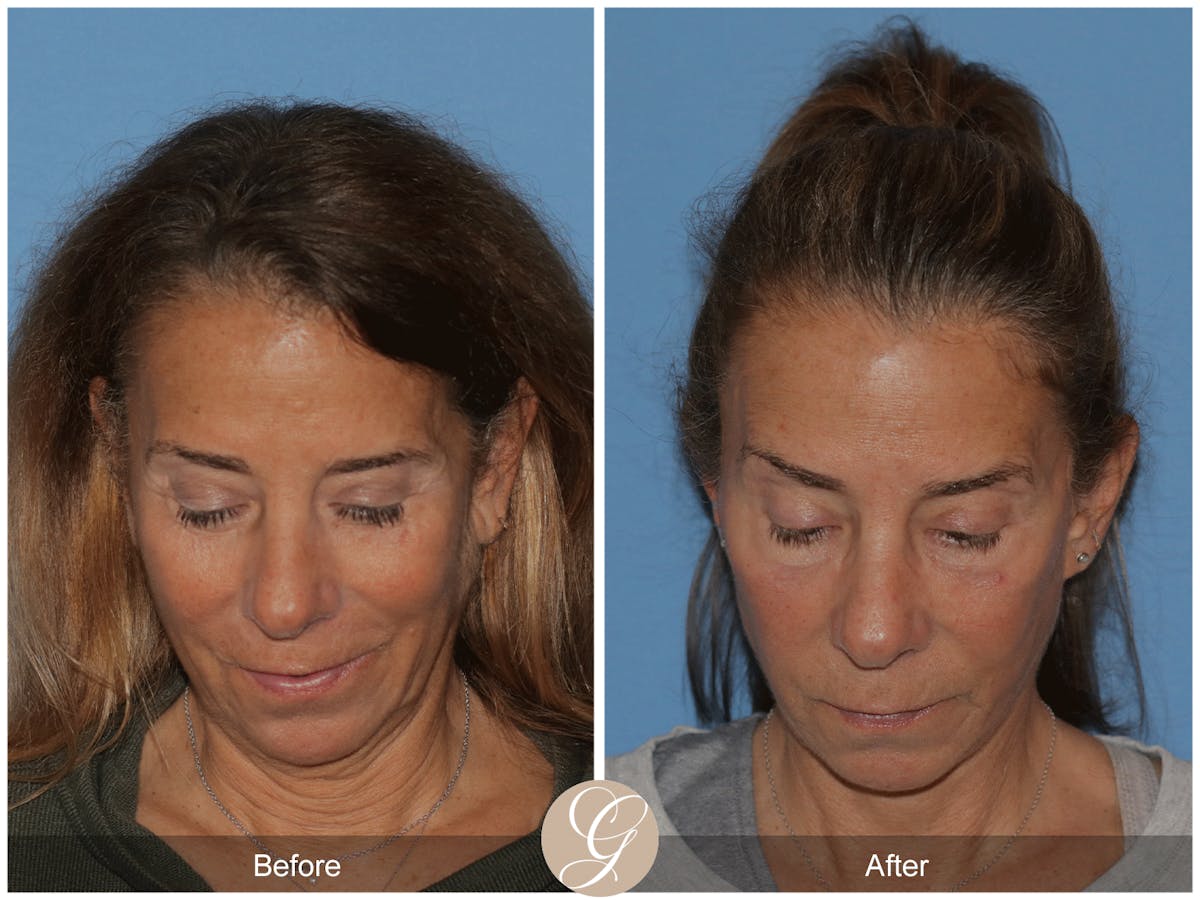 Deep Plane Facelift Before & After Gallery - Patient 178117 - Image 2
