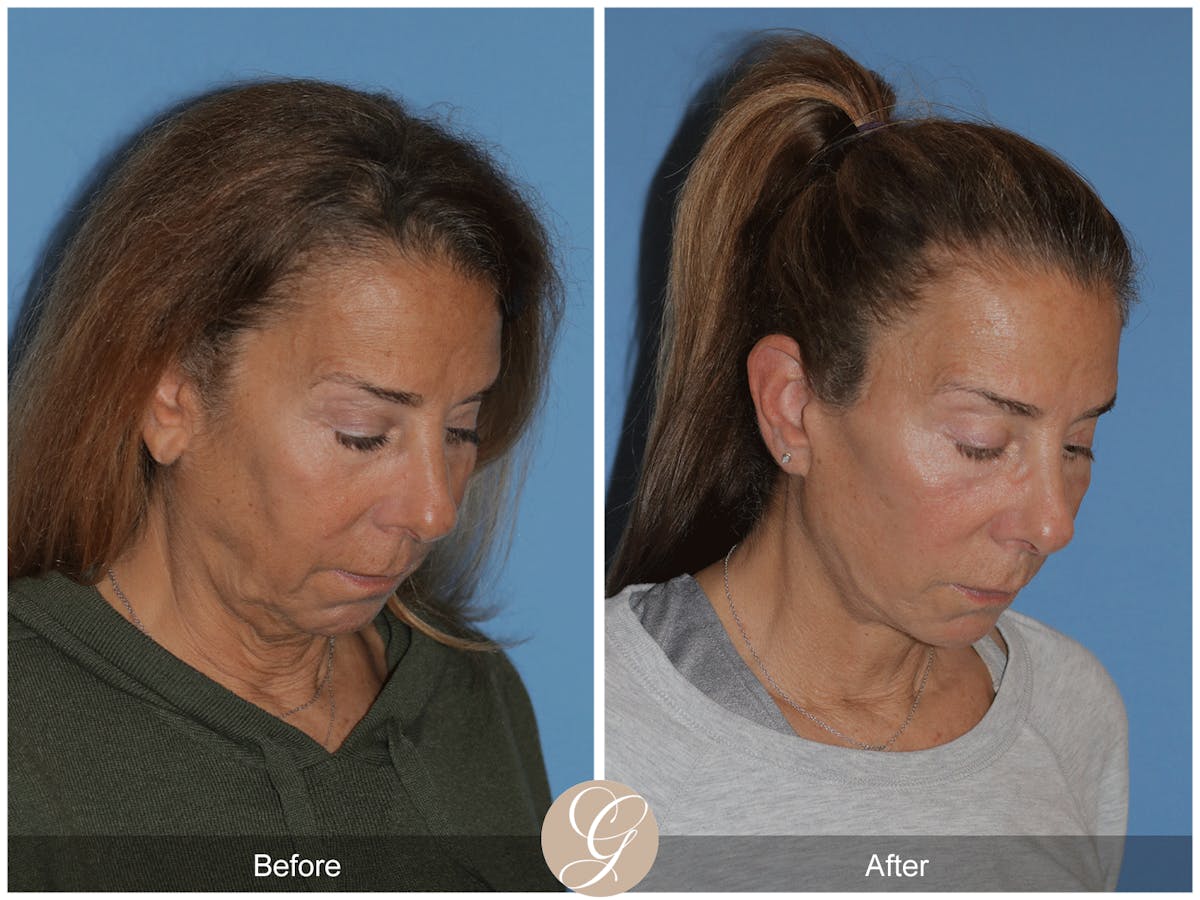 Deep Plane Facelift Before & After Gallery - Patient 178117 - Image 3