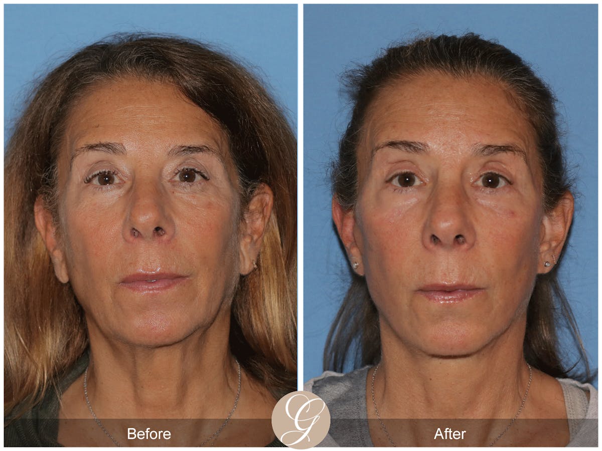 Deep Plane Facelift Before & After Gallery - Patient 178117 - Image 1