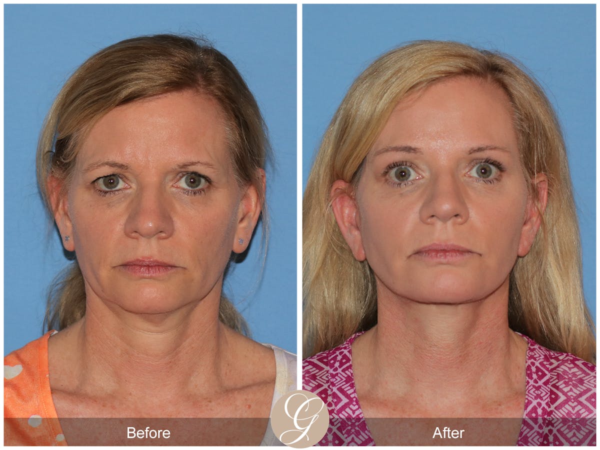 Deep Plane Facelift Before & After Gallery - Patient 197865 - Image 1