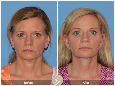 Deep Plane Facelift Before & After Gallery - Patient 197865 - Image 1
