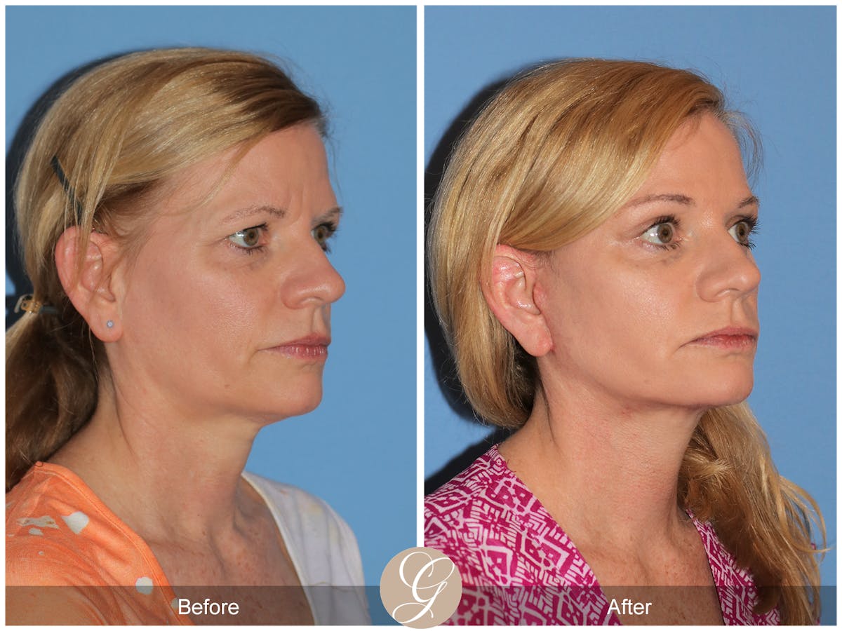 Deep Plane Facelift Before & After Gallery - Patient 197865 - Image 3