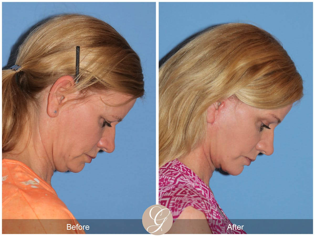 Deep Plane Facelift Before & After Gallery - Patient 197865 - Image 2
