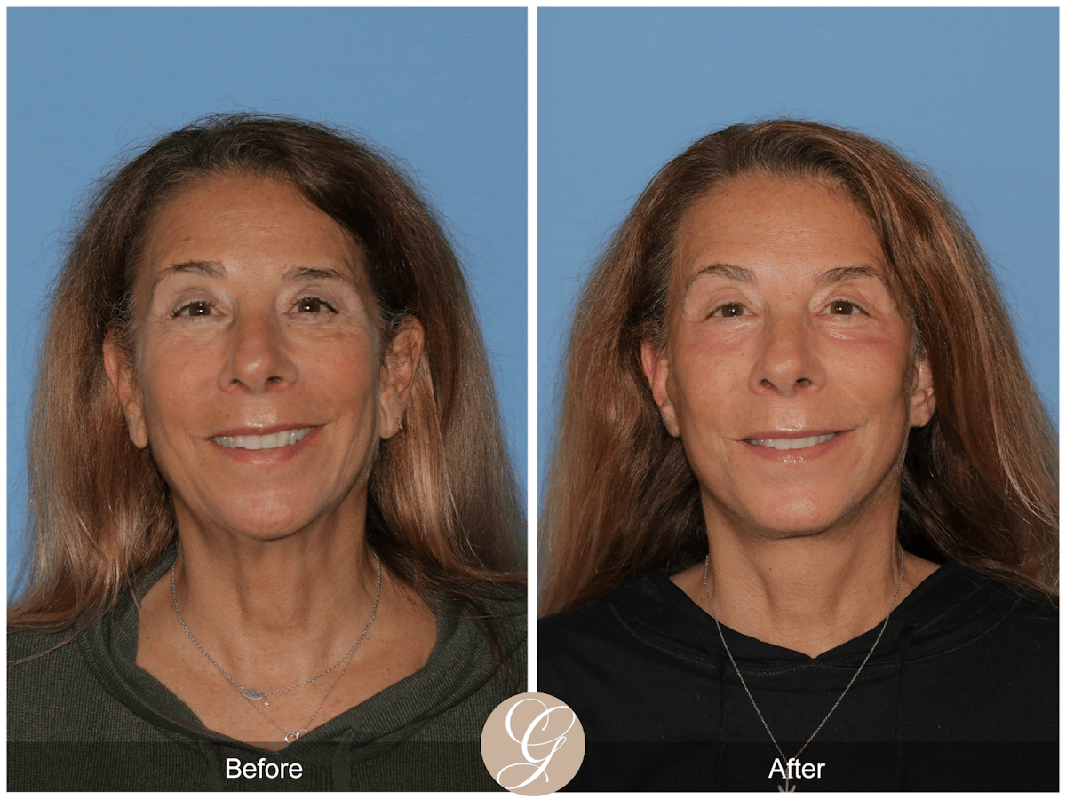 Preservation Facelift Before & After Gallery - Patient 423575 - Image 4