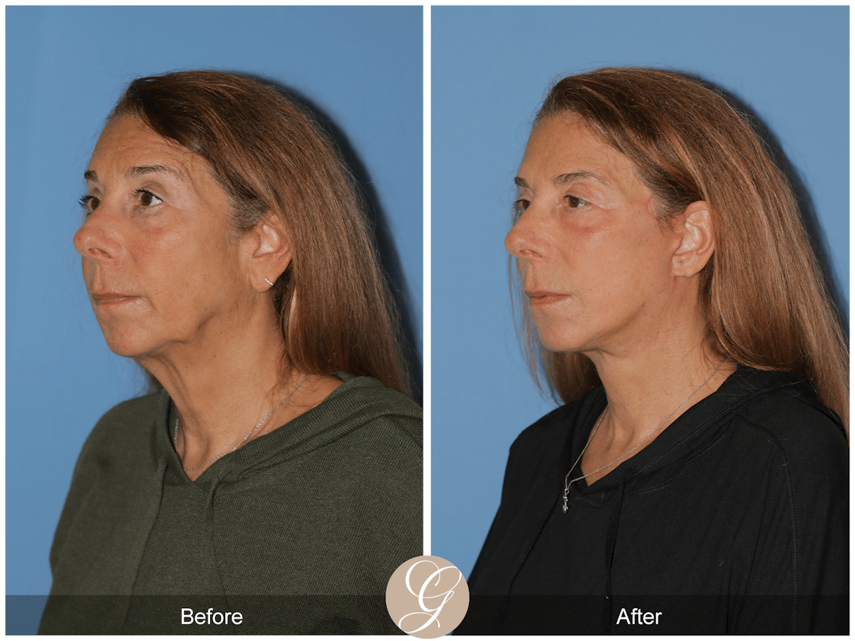 Preservation Facelift Before & After Gallery - Patient 423575 - Image 7