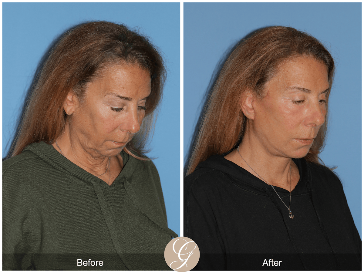 Preservation Facelift Before & After Gallery - Patient 423575 - Image 6