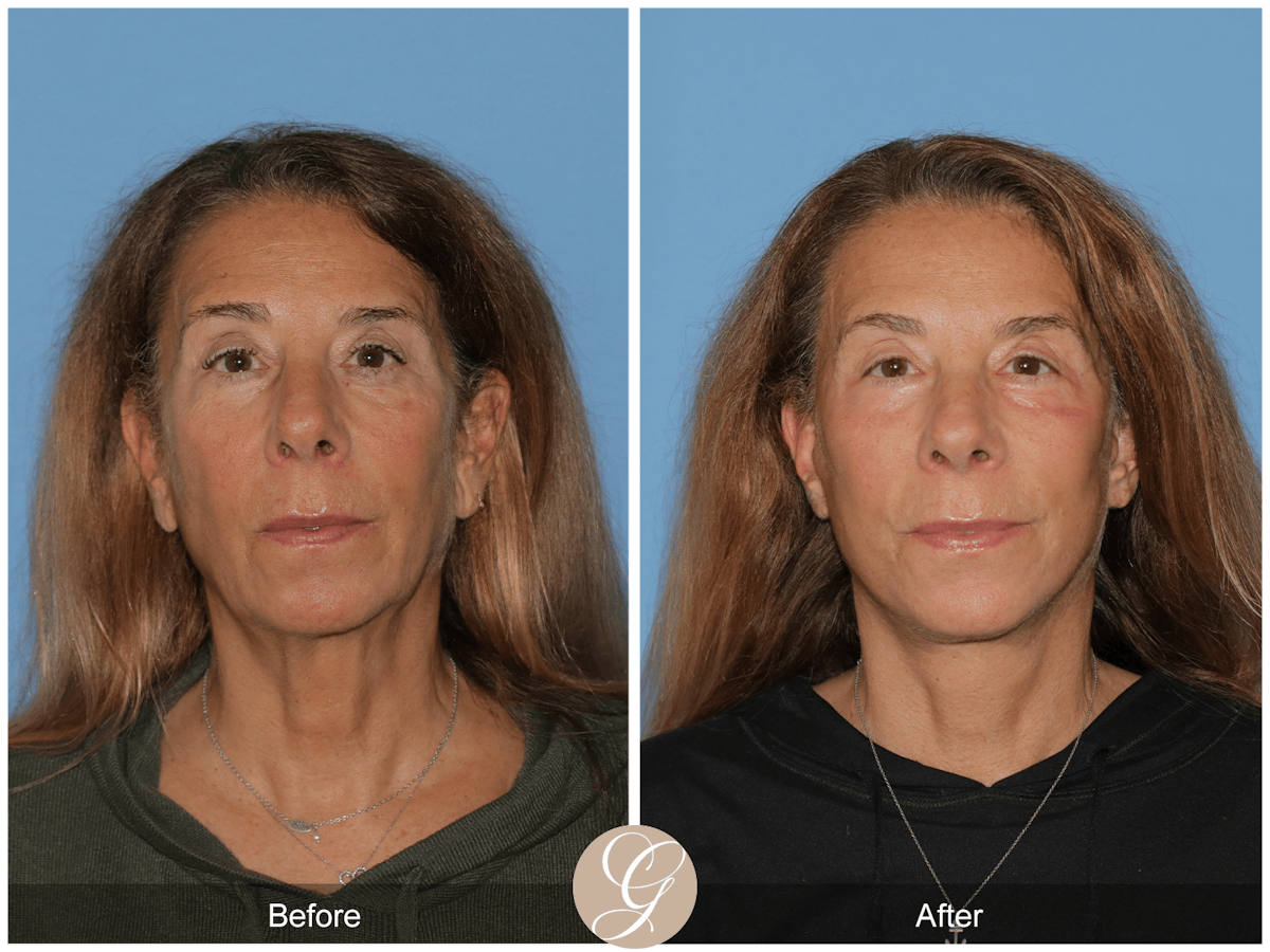 Preservation Facelift Before & After Gallery - Patient 423575 - Image 1
