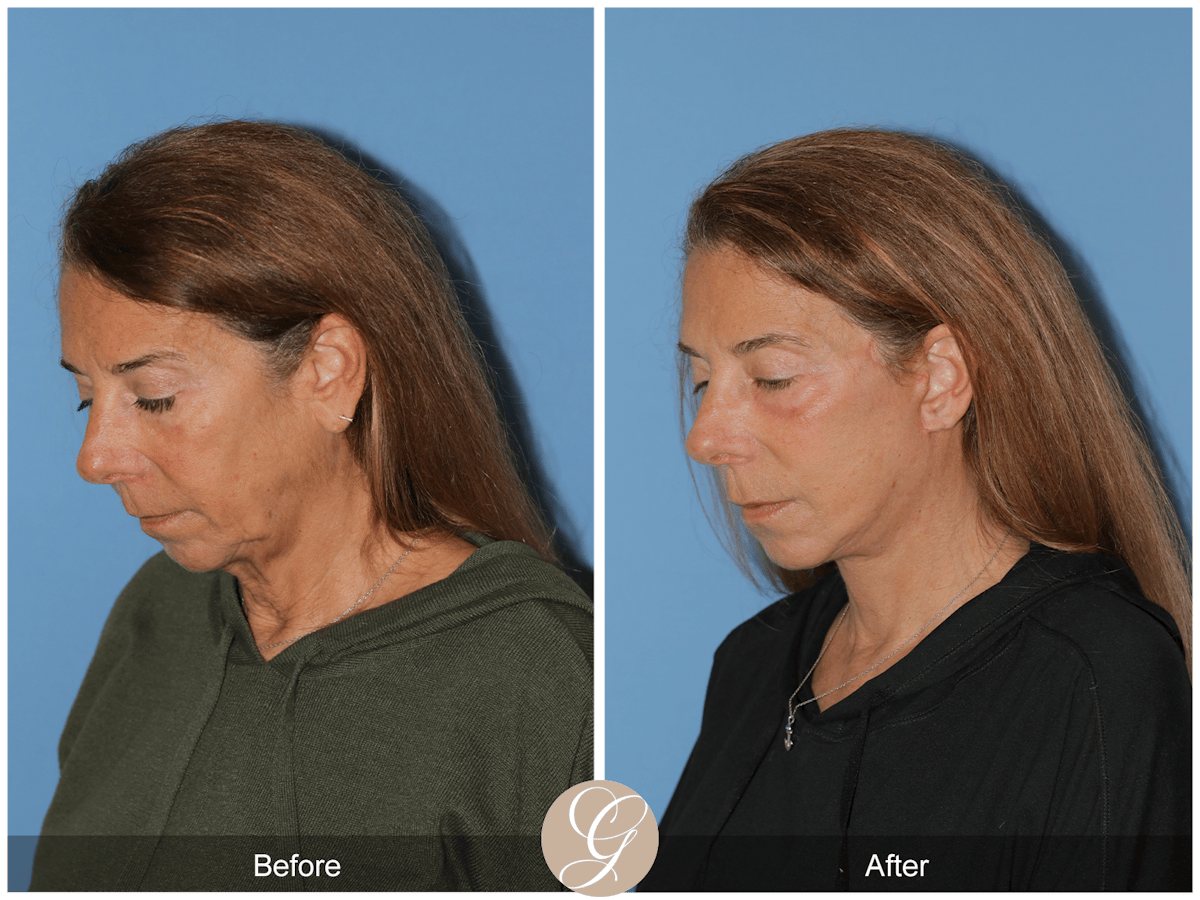 Preservation Facelift Before & After Gallery - Patient 423575 - Image 5