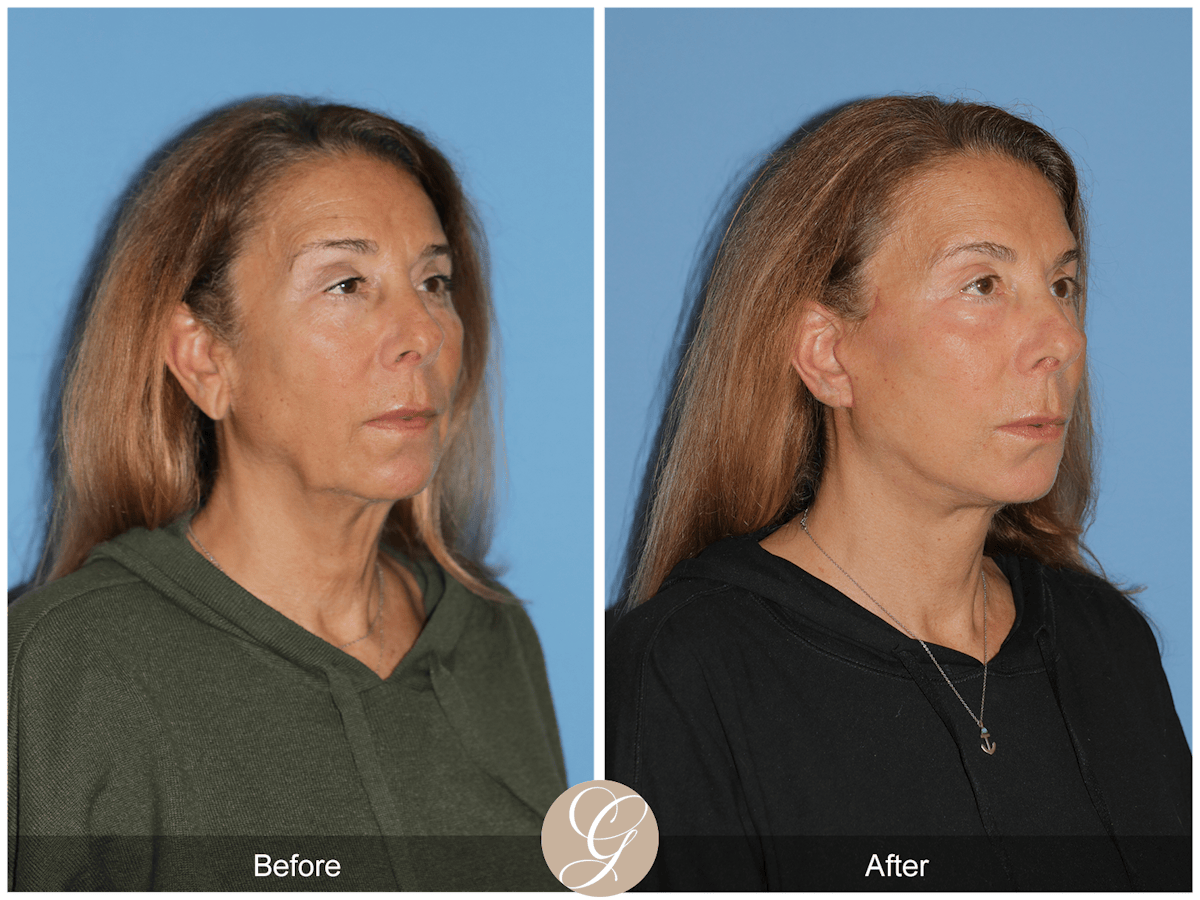 Preservation Facelift Before & After Gallery - Patient 423575 - Image 8