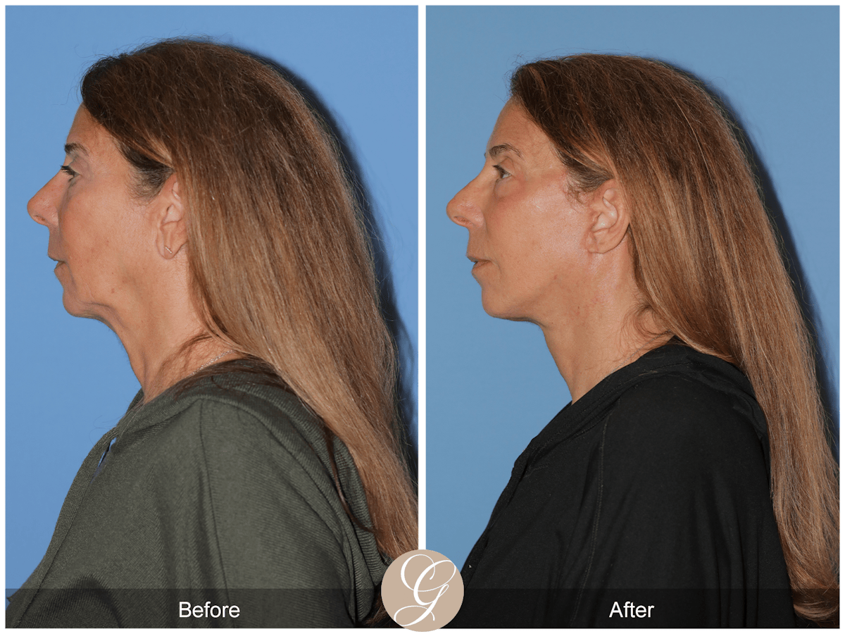 Preservation Facelift Before & After Gallery - Patient 423575 - Image 10