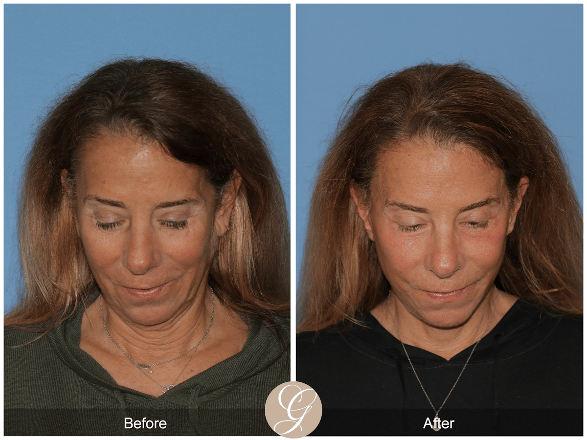 Preservation Facelift Before & After Gallery - Patient 423575 - Image 2