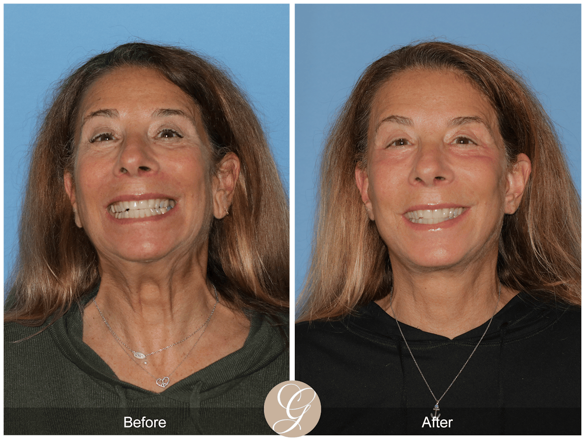 Preservation Facelift Before & After Gallery - Patient 423575 - Image 3