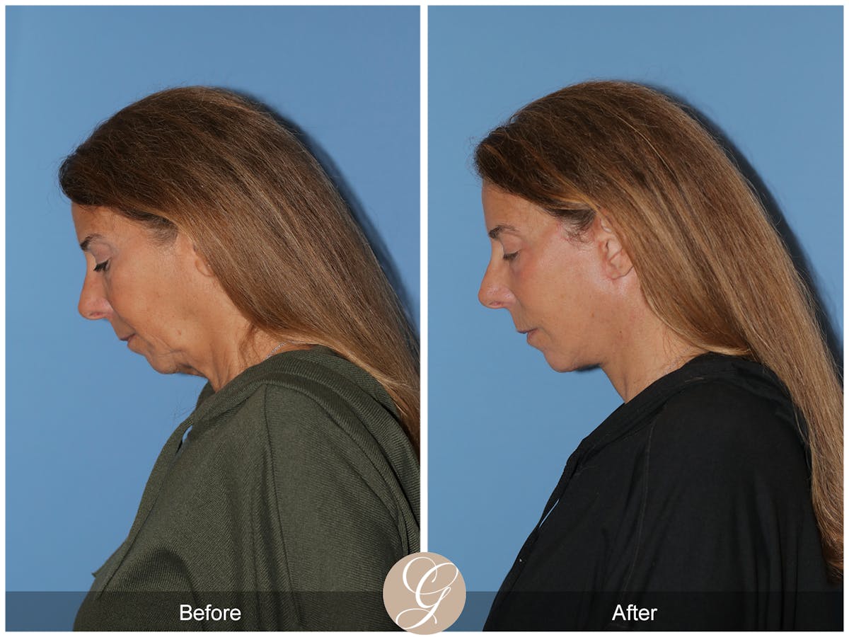 Preservation Facelift Before & After Gallery - Patient 423575 - Image 9