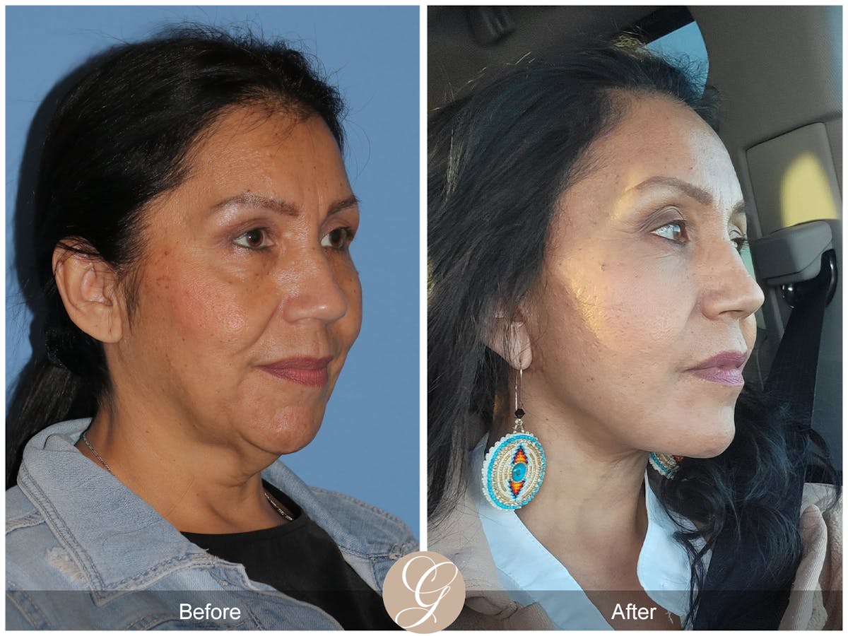 Preservation Facelift Before & After Gallery - Patient 613228 - Image 1