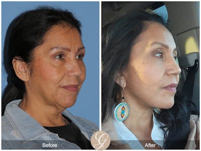 Preservation Facelift Before & After Gallery - Patient 613228 - Image 1