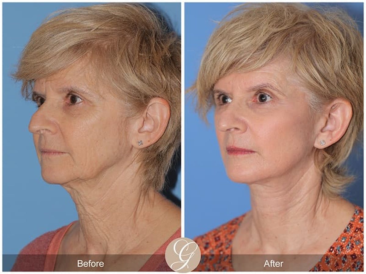 Preservation Facelift Before & After Gallery - Patient 281729 - Image 2