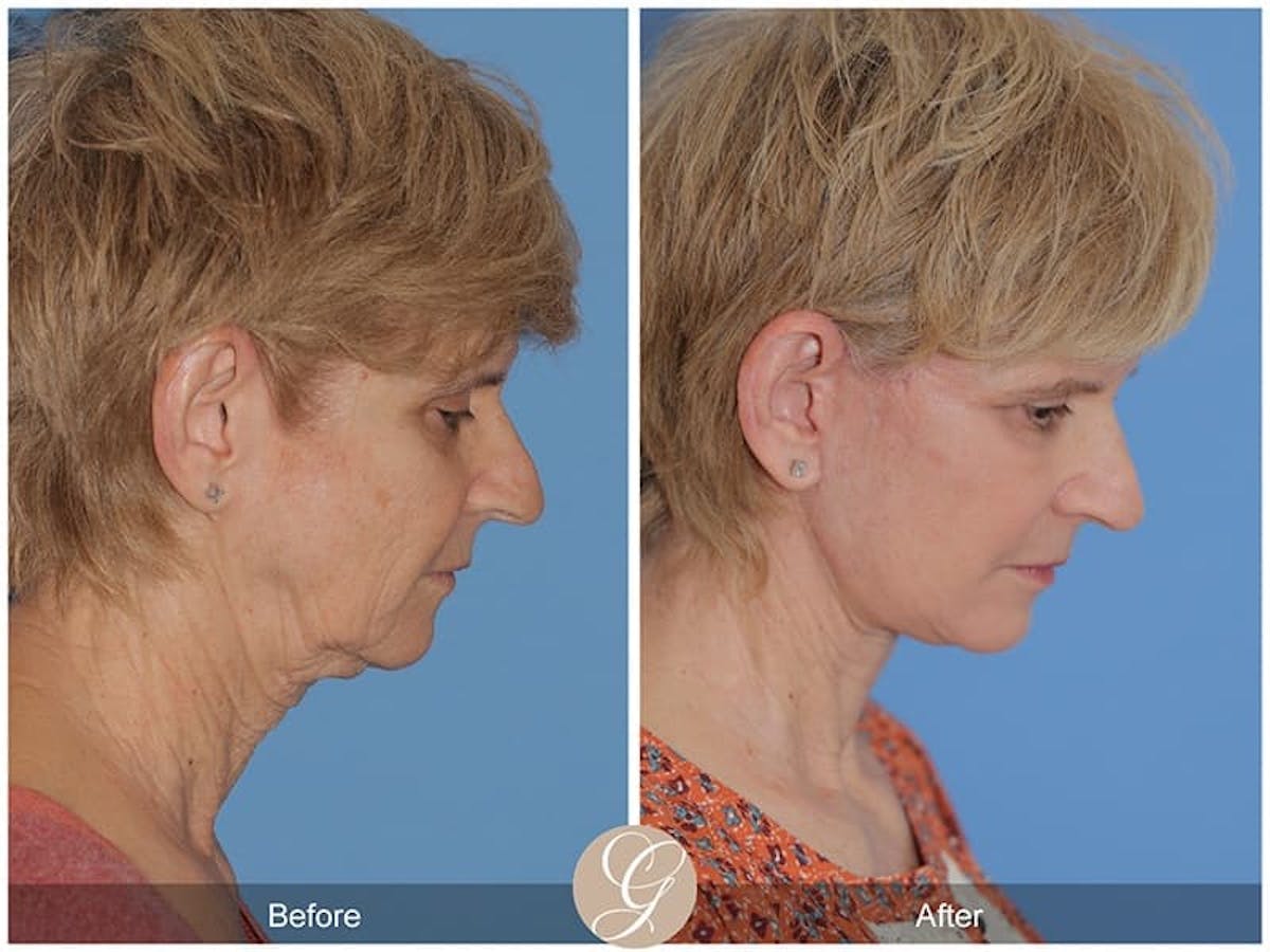 Preservation Facelift Before & After Gallery - Patient 281729 - Image 3