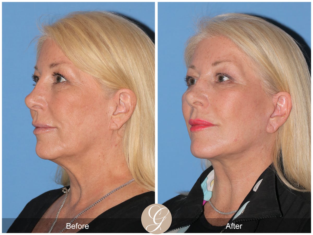 Preservation Facelift Before & After Gallery - Patient 193855 - Image 3