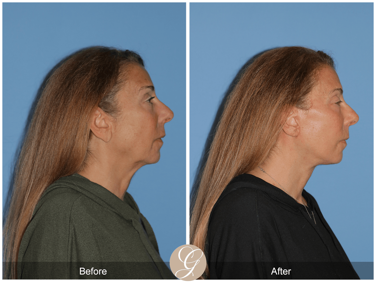 Preservation Facelift Before & After Gallery - Patient 423575 - Image 11