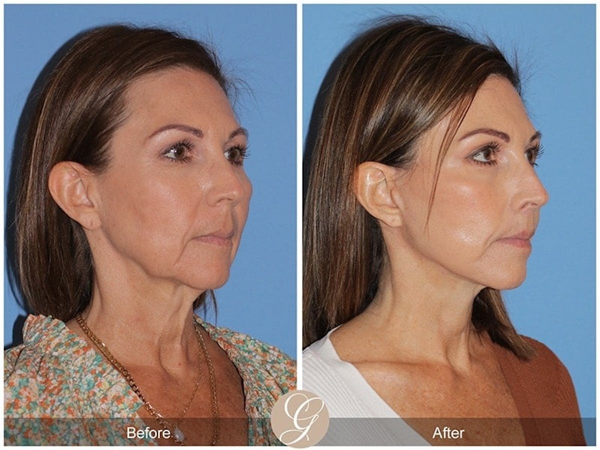 Preservation Facelift Before & After Gallery - Patient 357430 - Image 3