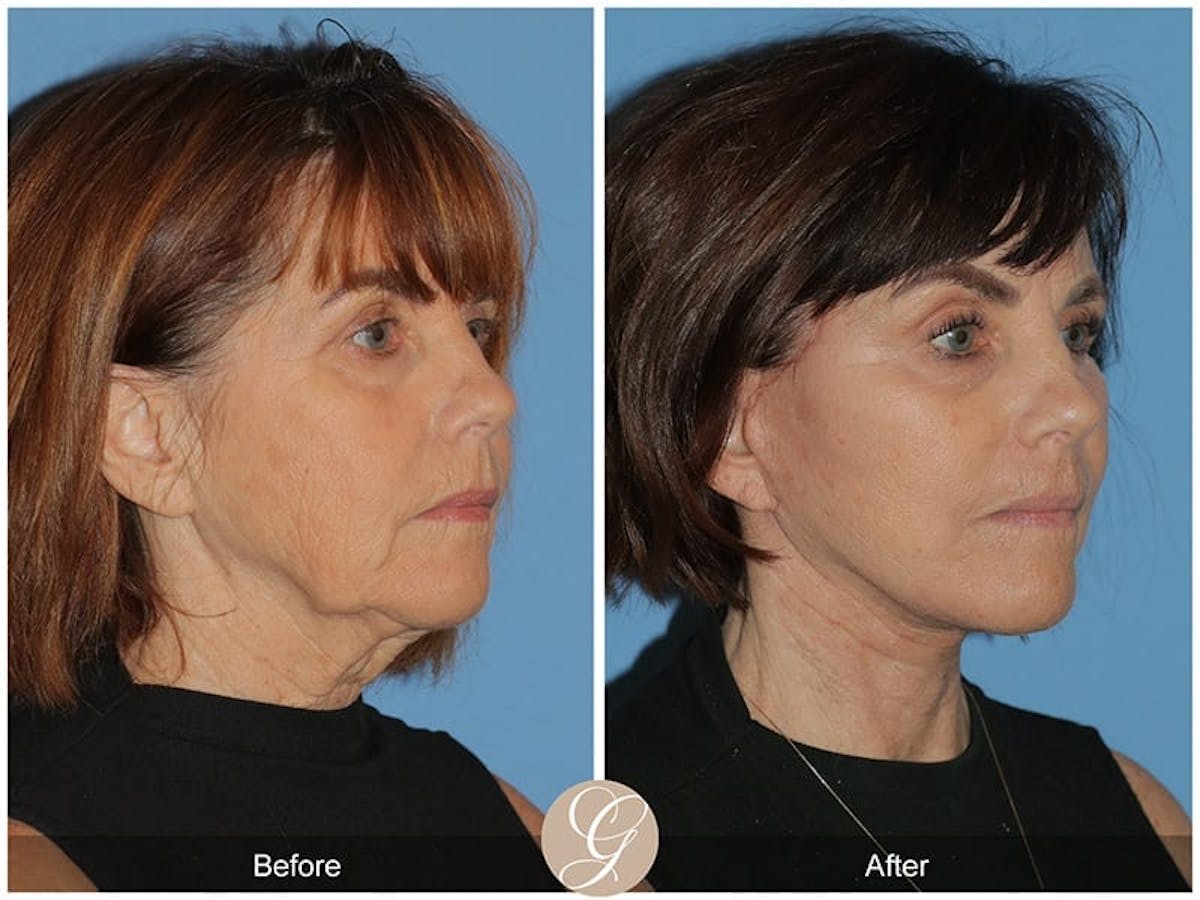 Preservation Facelift Before & After Gallery - Patient 293876 - Image 2