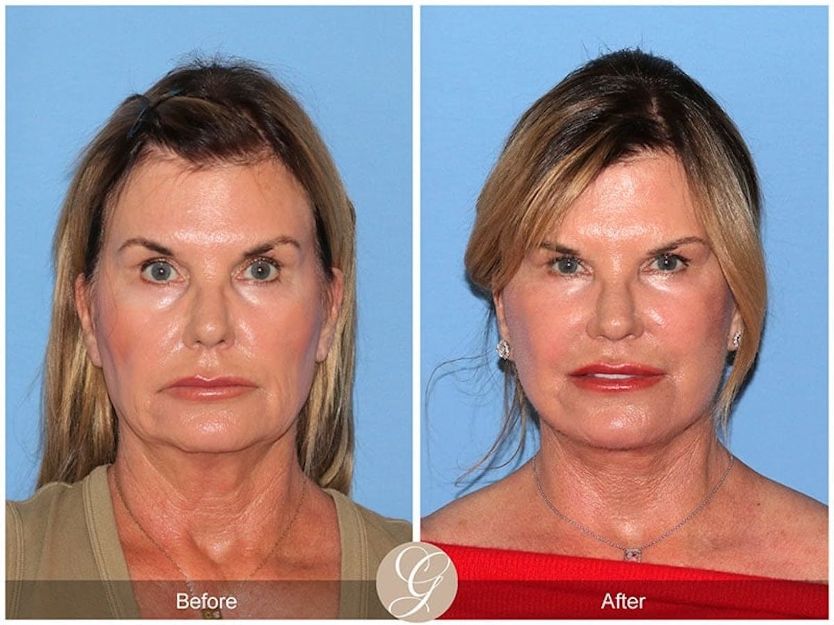 Preservation Facelift Before & After Gallery - Patient 967069 - Image 1