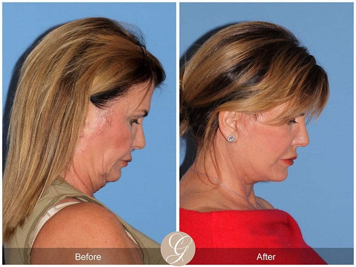 Preservation Facelift Before & After Gallery - Patient 967069 - Image 2