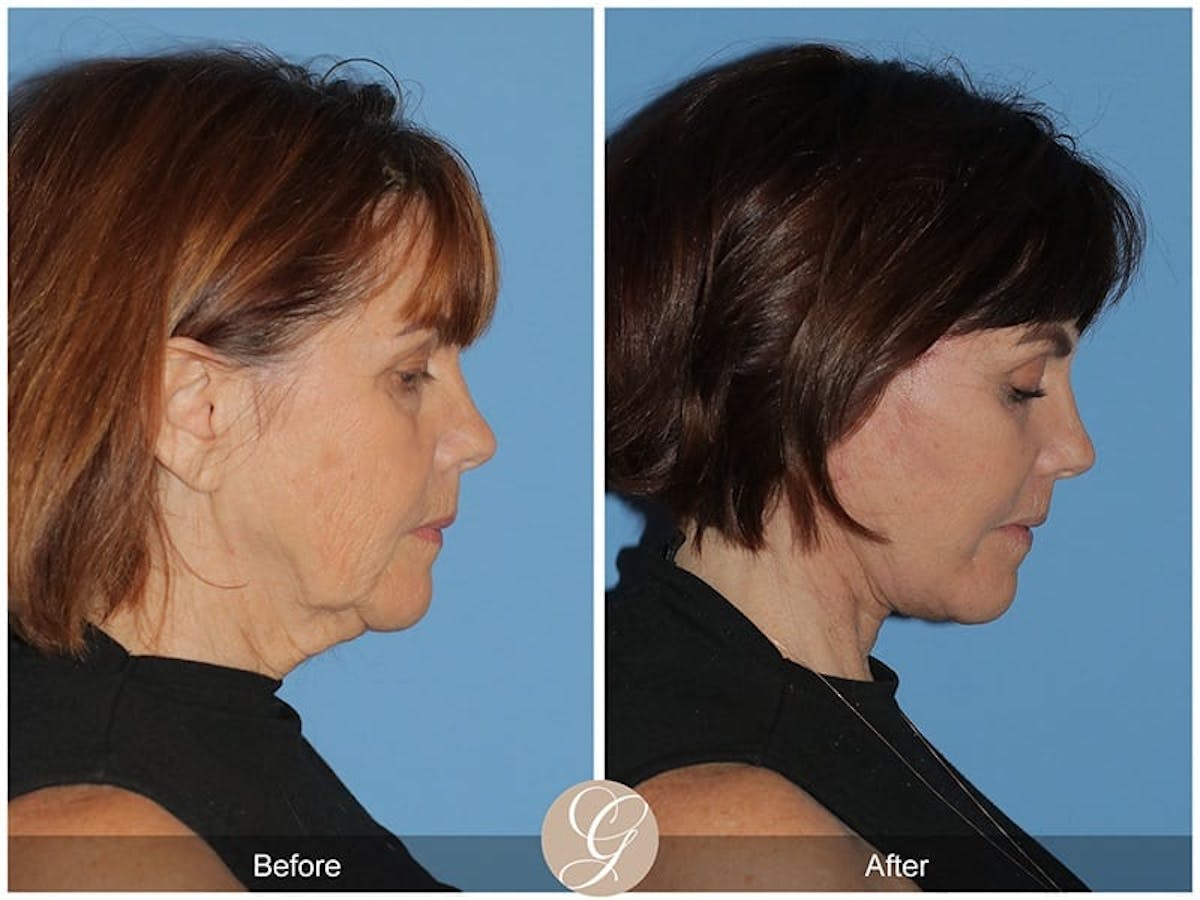 Preservation Facelift Before & After Gallery - Patient 293876 - Image 3