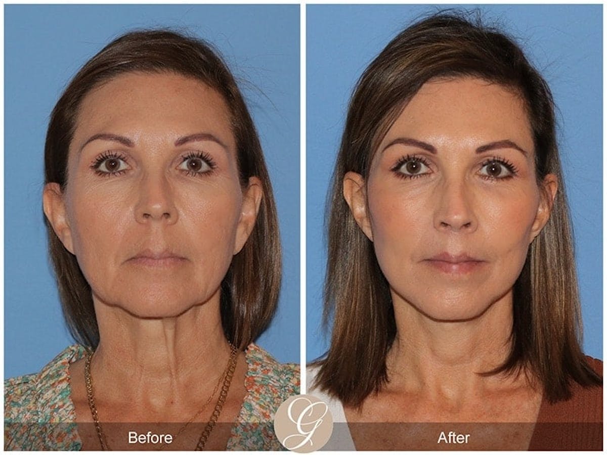 Preservation Facelift Before & After Gallery - Patient 357430 - Image 1