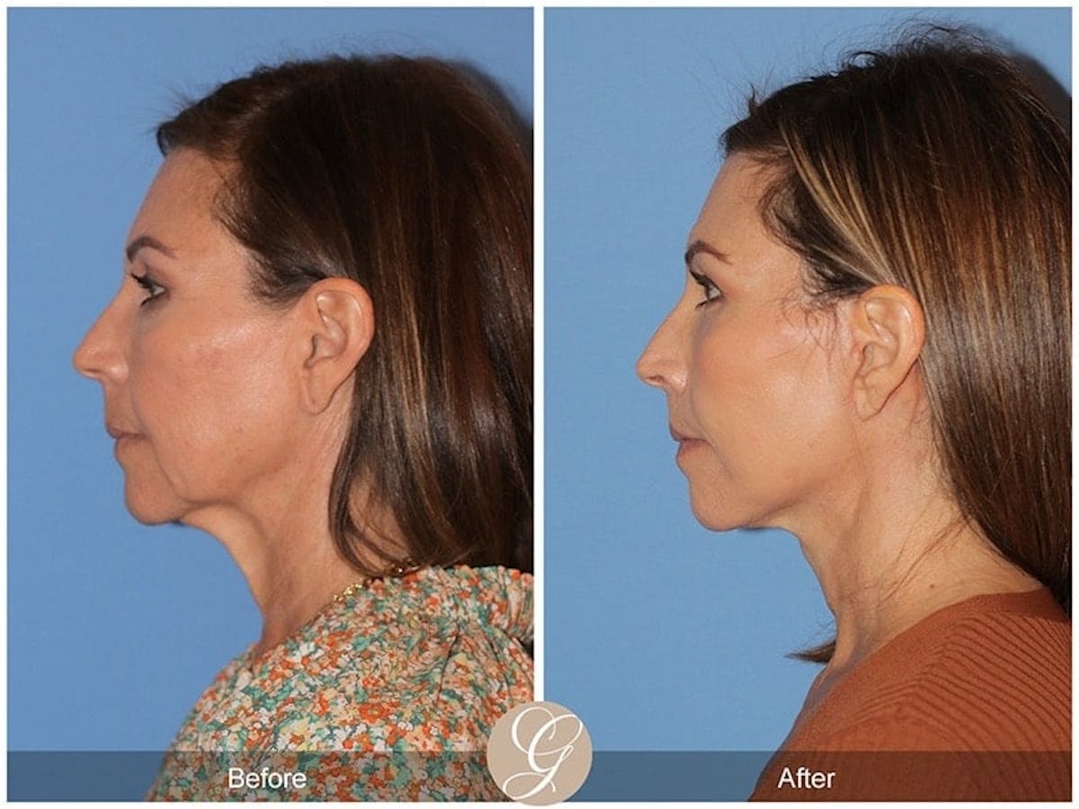 Preservation Facelift Before & After Gallery - Patient 357430 - Image 2