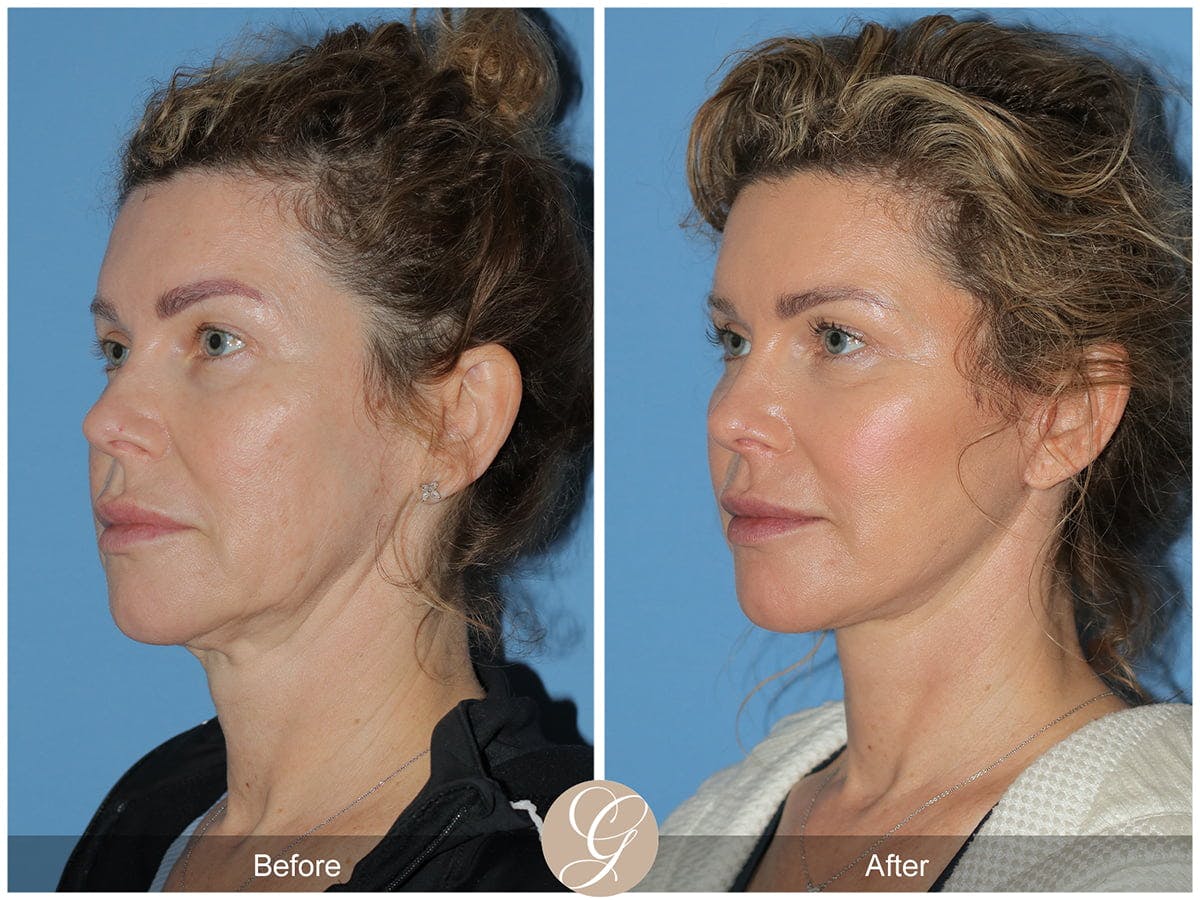 Preservation Facelift Before & After Gallery - Patient 142525 - Image 3