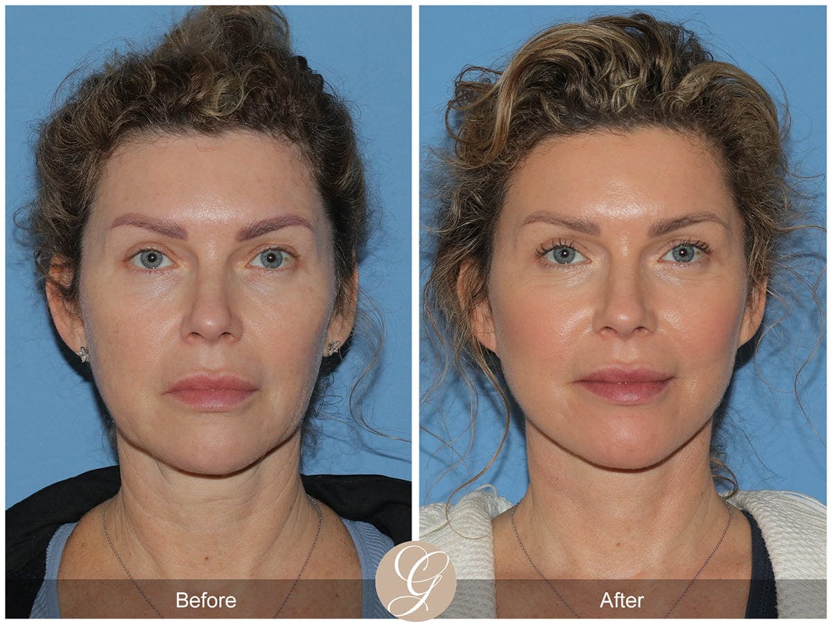 Preservation Facelift Before & After Gallery - Patient 142525 - Image 1