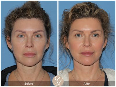 Deep Plane Facelift Before & After Gallery - Patient 208796 - Image 1
