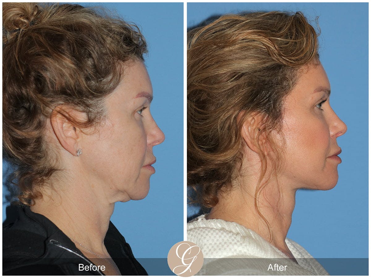 Preservation Facelift Before & After Gallery - Patient 142525 - Image 2
