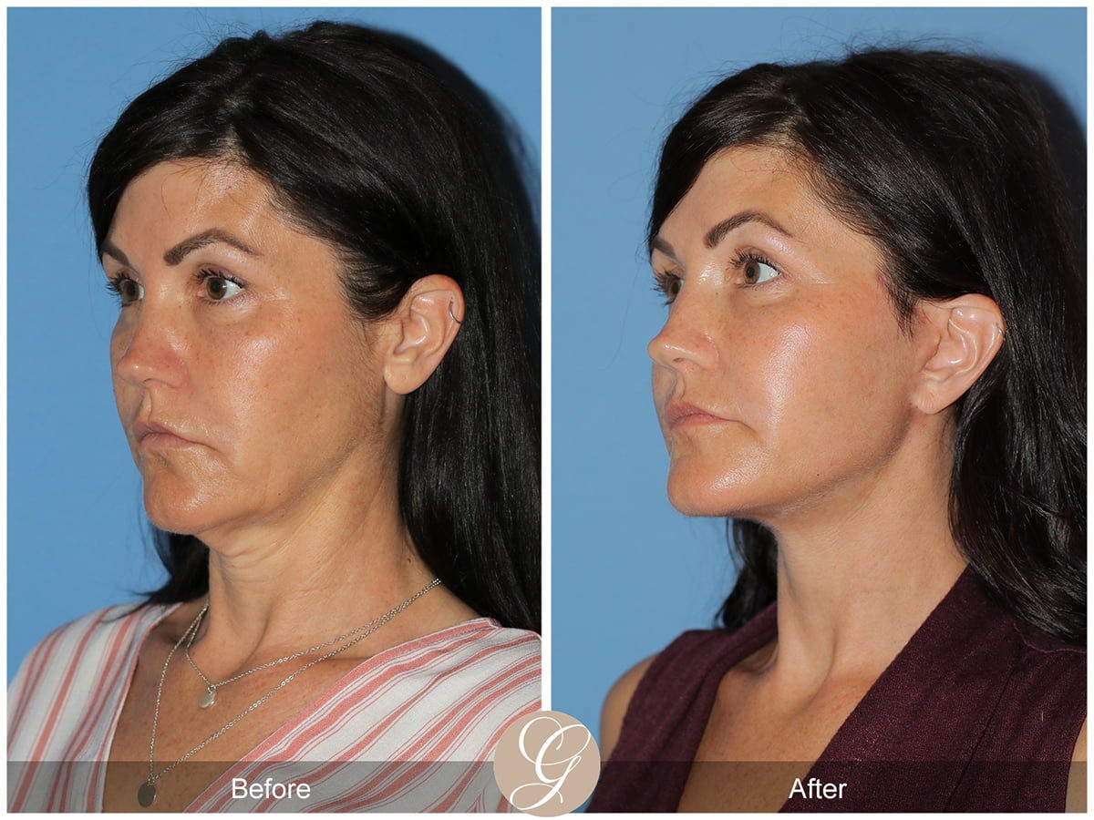 Preservation Facelift Before & After Gallery - Patient 244551 - Image 3
