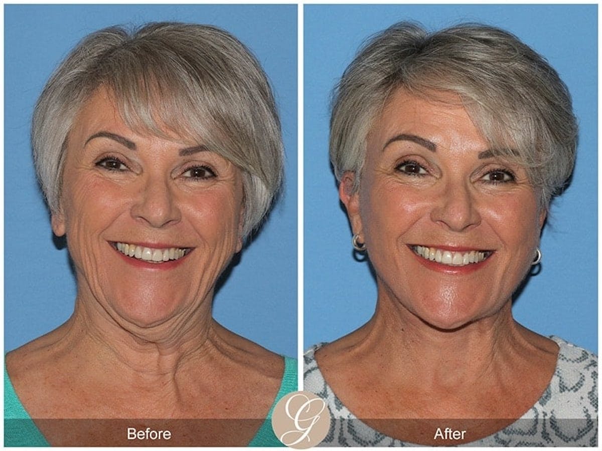 Preservation Facelift Before & After Gallery - Patient 238777 - Image 1